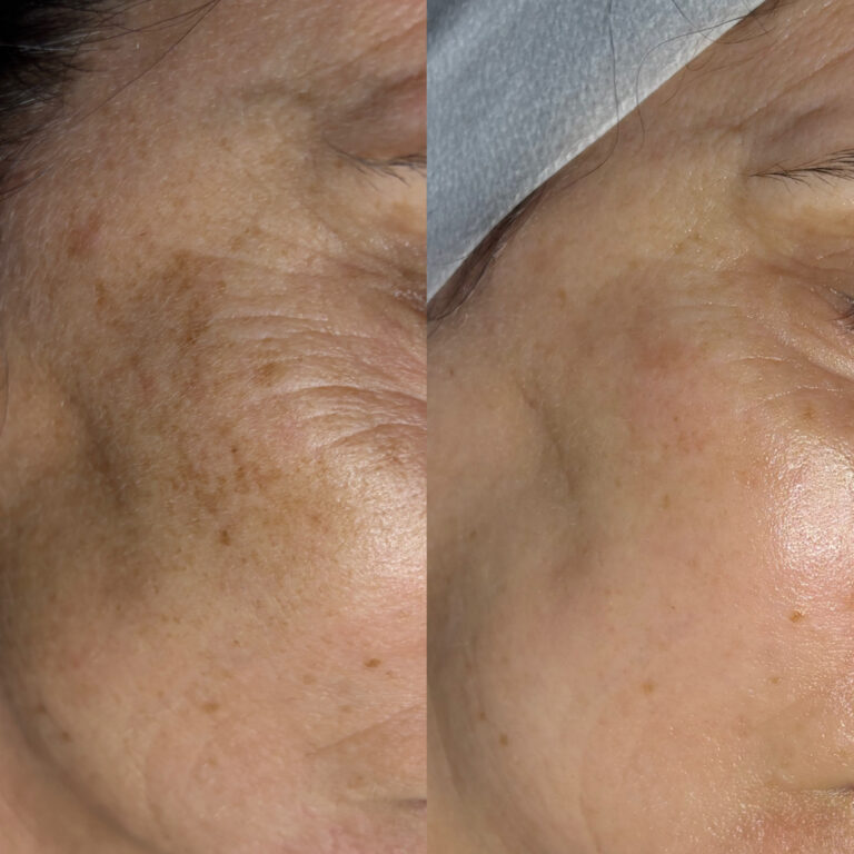 Starke Reduktion von Hyperpigmentierung und Faltentiefe