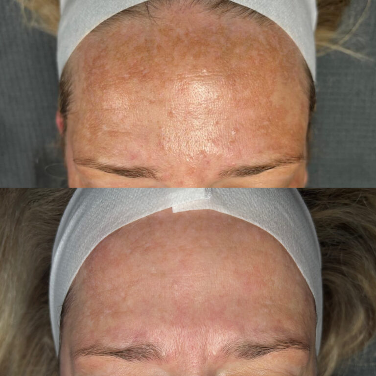 Deutliche Verbesserung Melasma