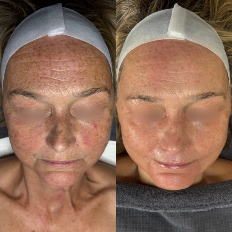 Verjüngung Hautbild und Aufhellung Hyperpigmentierungen